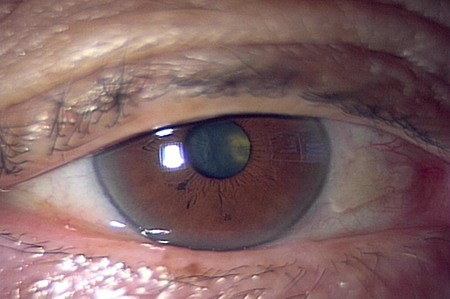 初期白内障とは何ですか?